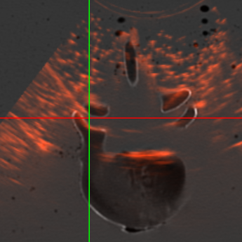 needle_insertion.png